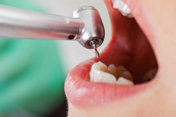Best Emergency Root Canal Treatment in Pocatello, ID